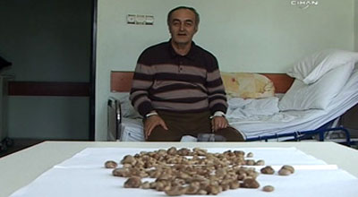 Xəstənin bir böyrəyindən 285 daş çıxdı